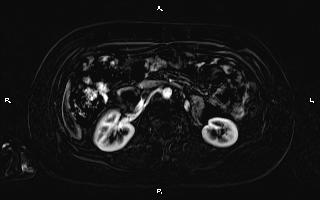 Bilateral adrenal myelolipoma (Radiopaedia 63058-71537 I 50).jpg