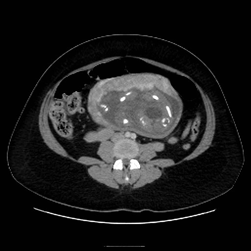 Bilateral adrenal thrombosis (Radiopaedia 58182-65256 A 42).jpg