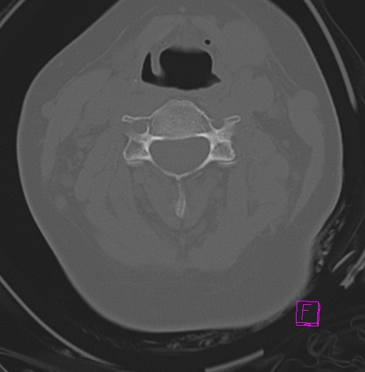 File:Bilateral atlanto-occipital assimilation (Radiopaedia 28350-28603 Axial bone window 20).jpg