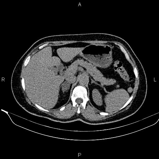 Bilateral benign adrenal adenomas (Radiopaedia 86912-103124 Axial non-contrast 35).jpg