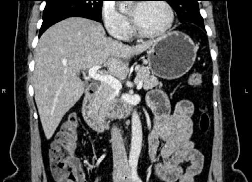 Bilateral benign adrenal adenomas (Radiopaedia 86912-103124 D 26).jpg