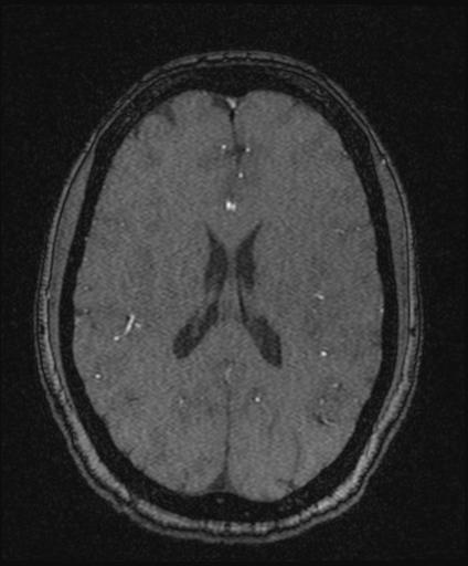 Bilateral carotid body tumors and right glomus jugulare tumor (Radiopaedia 20024-20060 Axial MRA 115).jpg