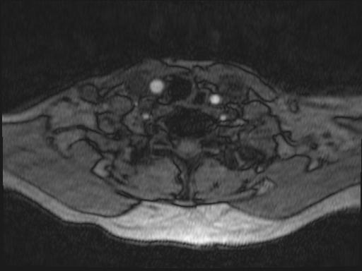 Bilateral carotid body tumors and right glomus jugulare tumor (Radiopaedia 20024-20060 Axial MRA 195).jpg