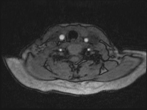 Bilateral carotid body tumors and right glomus jugulare tumor (Radiopaedia 20024-20060 Axial MRA 206).jpg