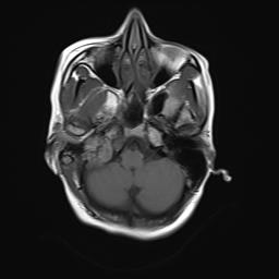 File:Bilateral carotid body tumors and right jugular paraganglioma (Radiopaedia 20024-20060 Axial 23).jpg