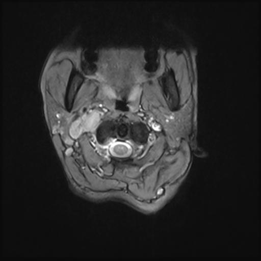 File:Bilateral carotid body tumors and right jugular paraganglioma (Radiopaedia 20024-20060 Axial 67).jpg
