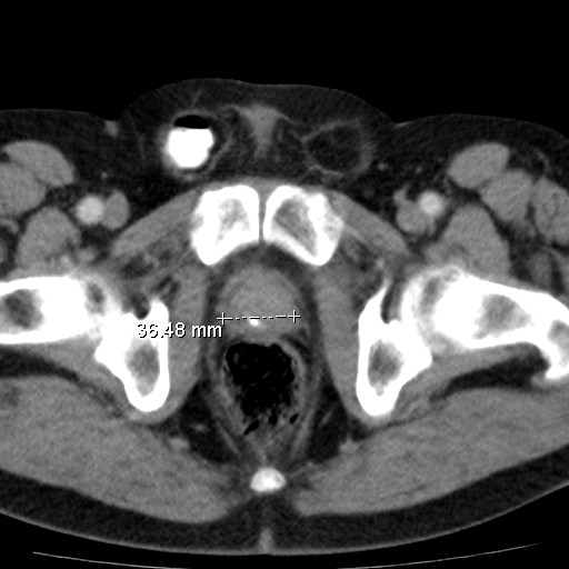 File:Bilateral direct inguinal herniae (Radiopaedia 17016-16719 B 23).jpg