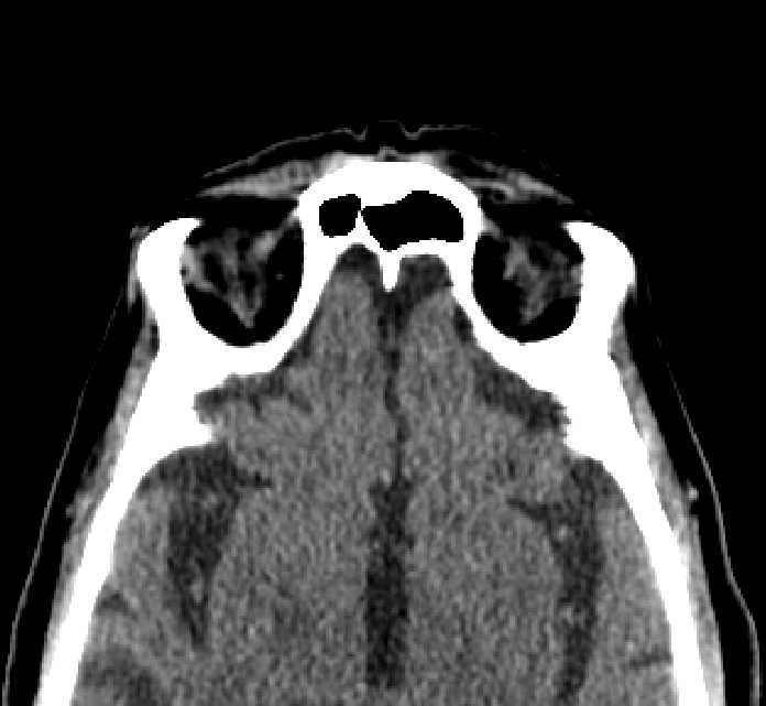 Bilateral ectopia lentis (Radiopaedia 89889-107013 Axial non-contrast 12).jpg