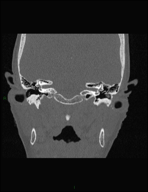 Bilateral frontal mucoceles (Radiopaedia 82352-96454 Coronal 303).jpg