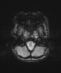 Bilateral mesial temporal polymicrogyria (Radiopaedia 76456-88181 Axial SWI 3).jpg