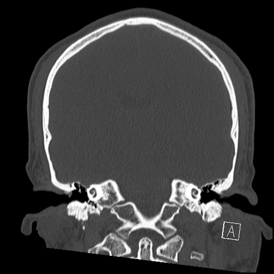 Bilateral occipital condyle fracture (type 2) (Radiopaedia 87675-104089 Coronal bone window 74).jpg