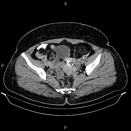 Bilateral ovarian dermoid cysts (Radiopaedia 85785-101603 A 90).jpg