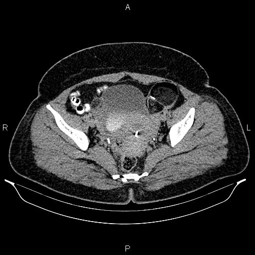Bilateral ovarian dermoid cysts (Radiopaedia 85785-101603 Axial C+ delayed 71).jpg