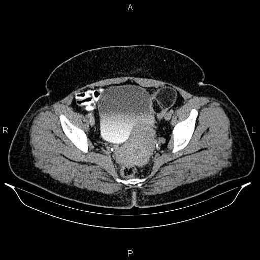 File:Bilateral ovarian dermoid cysts (Radiopaedia 85785-101603 Axial C+ delayed 74).jpg