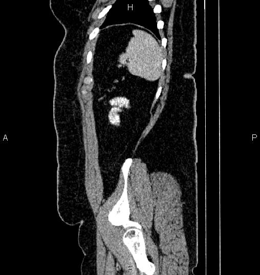 Bilateral ovarian dermoid cysts (Radiopaedia 85785-101603 D 84).jpg