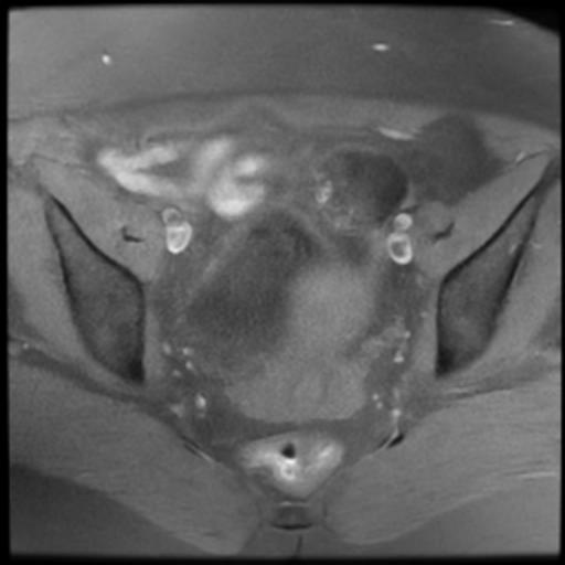 File:Bilateral ovarian dermoid cysts (Radiopaedia 90152-107338 Axial T1 fat sat 12).jpg