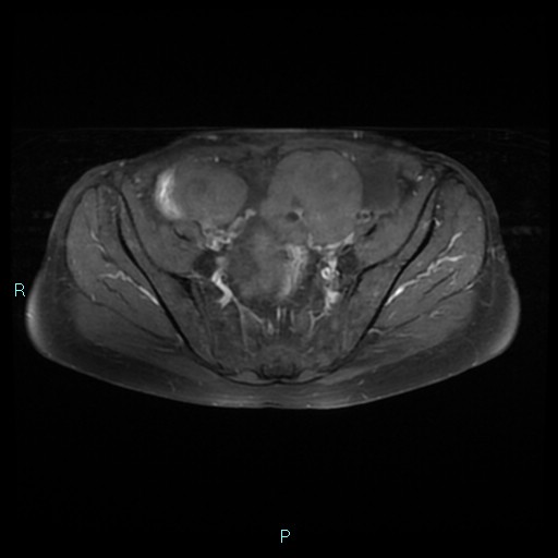File:Bilateral ovarian fibroma (Radiopaedia 44568-48293 Axial T1 C+ fat sat 10).jpg