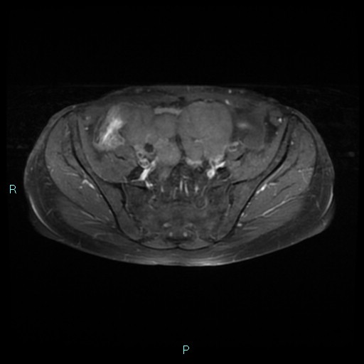 File:Bilateral ovarian fibroma (Radiopaedia 44568-48293 Axial T1 C+ fat sat 8).jpg