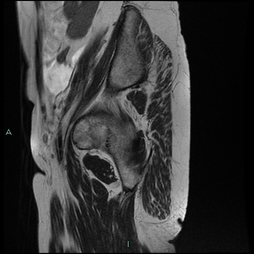 File:Bilateral ovarian fibroma (Radiopaedia 44568-48293 Sagittal T2 4).jpg