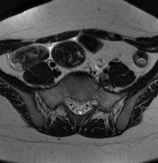 File:Bilateral ovarian fibrothecomas - adolescent (Radiopaedia 86604-102707 Axial T2 7).jpg
