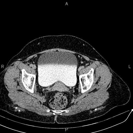 Bilateral ovarian serous cystadenocarcinoma (Radiopaedia 86062-101989 Axial C+ delayed 72).jpg