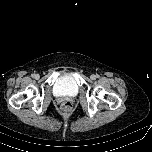 File:Bilateral ovarian serous cystadenocarcinoma (Radiopaedia 86062-101989 Axial C+ delayed 82).jpg