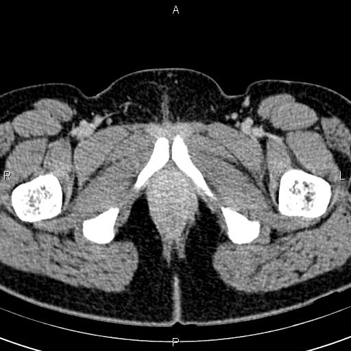 File:Bilateral ovarian teratoma (Radiopaedia 83131-97503 B 87).jpg