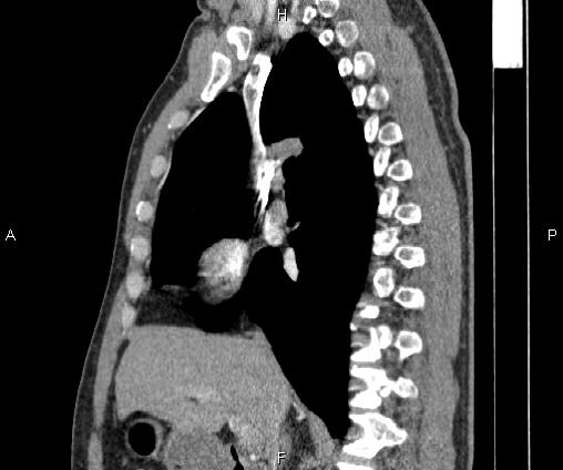 Bilateral pulmonary AVM (Radiopaedia 83134-97505 D 52).jpg