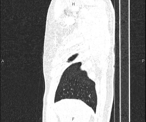 Bilateral pulmonary AVM (Radiopaedia 83134-97505 Sagittal lung window 20).jpg
