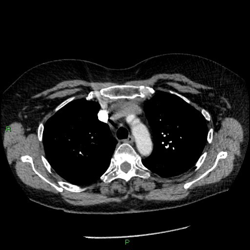 Bilateral pulmonary emboli (Radiopaedia 32700-33669 Axial C+ CTPA 31).jpg