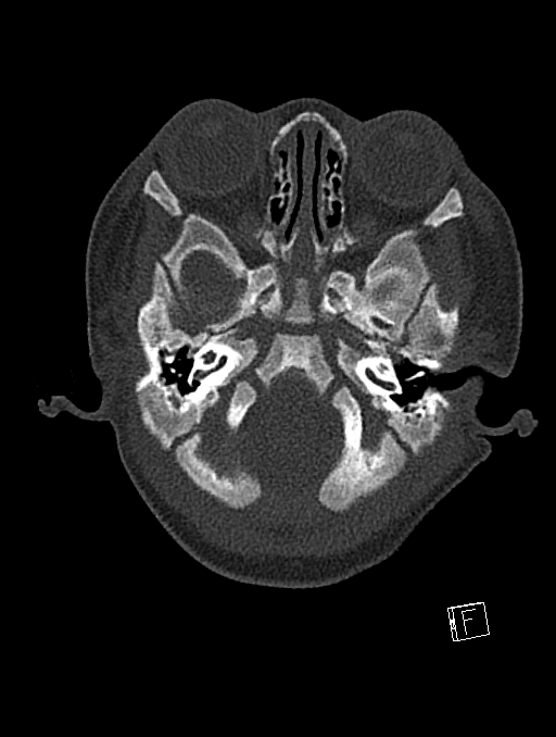 Bilateral subdural hemorrhage and parietal skull fracture (Radiopaedia 26058-26192 Axial bone window 111).png