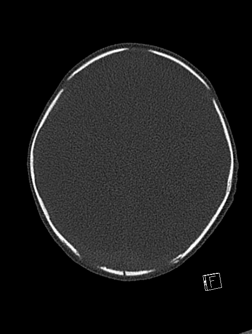 Bilateral subdural hemorrhage and parietal skull fracture (Radiopaedia 26058-26192 Axial bone window 39).png