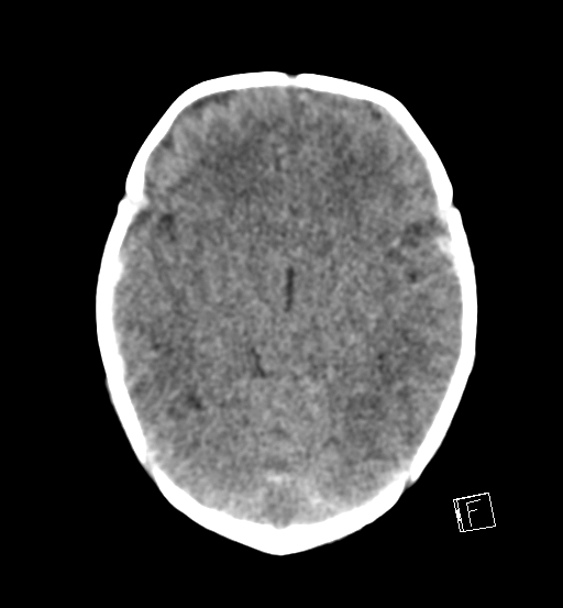 File:Bilateral subdural hemorrhage and parietal skull fracture (Radiopaedia 26058-26192 Axial non-contrast 15).png