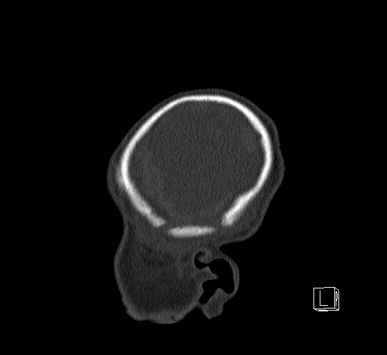Bilateral subdural hemorrhage and parietal skull fracture (Radiopaedia 26058-26192 Sagittal bone window 7).png