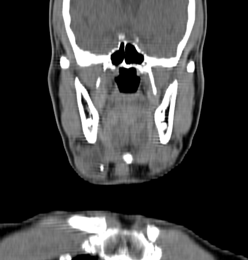 File:Bilateral submandibular sialolithiasis with sialadenitis (Radiopaedia 70721-80881 Coronal non-contrast 23).jpg