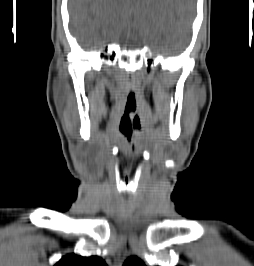 File:Bilateral submandibular sialolithiasis with sialadenitis (Radiopaedia 70721-80881 Coronal non-contrast 51).jpg