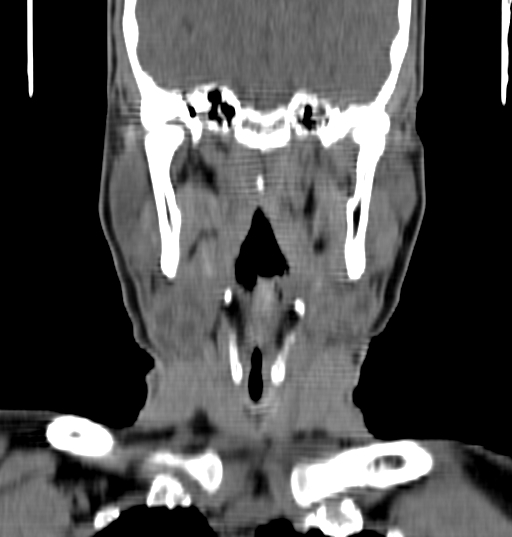 Bilateral submandibular sialolithiasis with sialadenitis (Radiopaedia 70721-80881 Coronal non-contrast 59).jpg