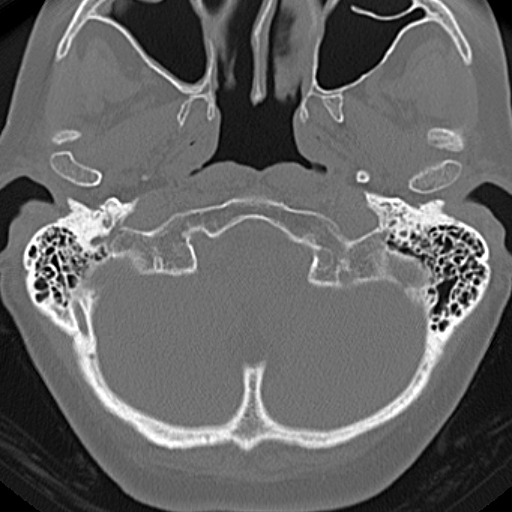 File:Bilateral tympanoplasty (Radiopaedia 16947-16664 Axial bone window 27).jpg