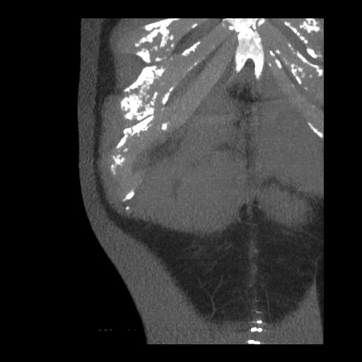 File:Bile leak from liver traumatic laceration (Radiopaedia 63463-72077 Coronal Biliscopin 3).jpg