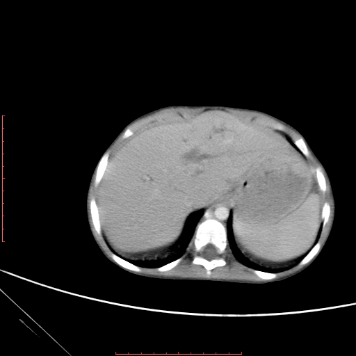 File:Biliary tract embryonal rhabdomyosarcoma (Radiopaedia 51815-57648 A 9).jpg
