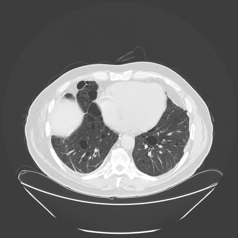 Birt-Hogg-Dubé syndrome (Radiopaedia 52578-58491 Axial lung window 42).jpg