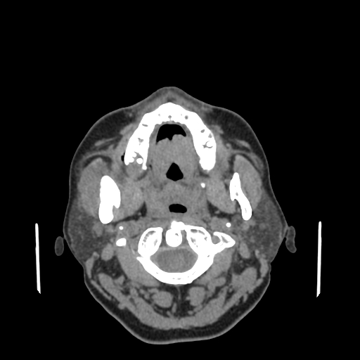 Bisphosphonate-related osteonecrosis of the jaw (Radiopaedia 71324-81642 non-contrast 104).jpg