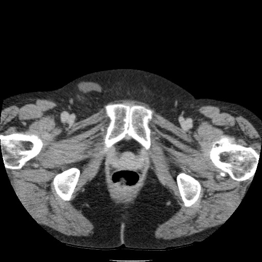 Bladder tumor detected on trauma CT (Radiopaedia 51809-57609 C 143).jpg