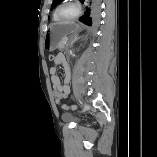 Blunt abdominal trauma with solid organ and musculoskelatal injury with active extravasation (Radiopaedia 68364-77895 C 90).jpg
