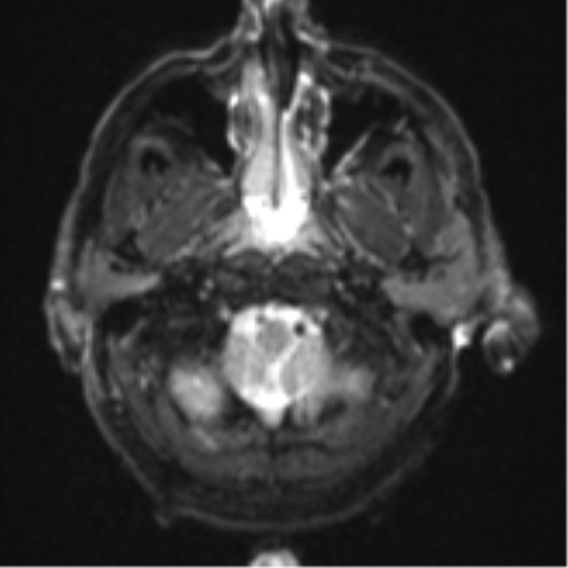 Blunt cerebrovascular injury (Radiopaedia 53682-59745 Axial DWI 4).png