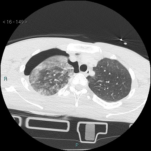 Blunt chest trauma (Swiss cheese sign) (Radiopaedia 38519-40618 Axial lung window 14).jpg