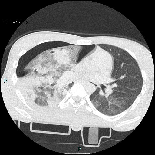 Blunt chest trauma (Swiss cheese sign) (Radiopaedia 38519-40618 Axial lung window 35).jpg