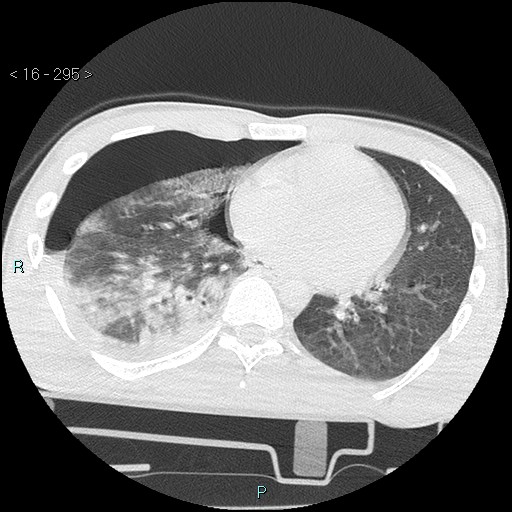 Blunt chest trauma (Swiss cheese sign) (Radiopaedia 38519-40618 Axial lung window 47).jpg