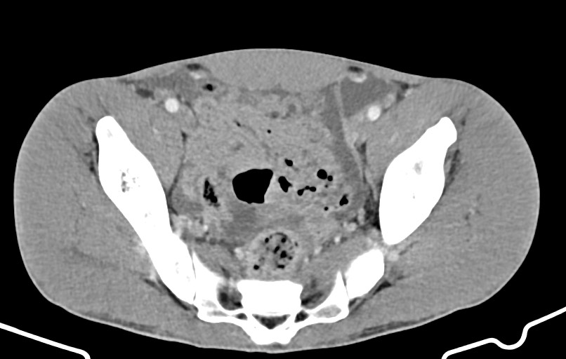Blunt injury to the small bowel (Radiopaedia 74953-85987 A 164).jpg