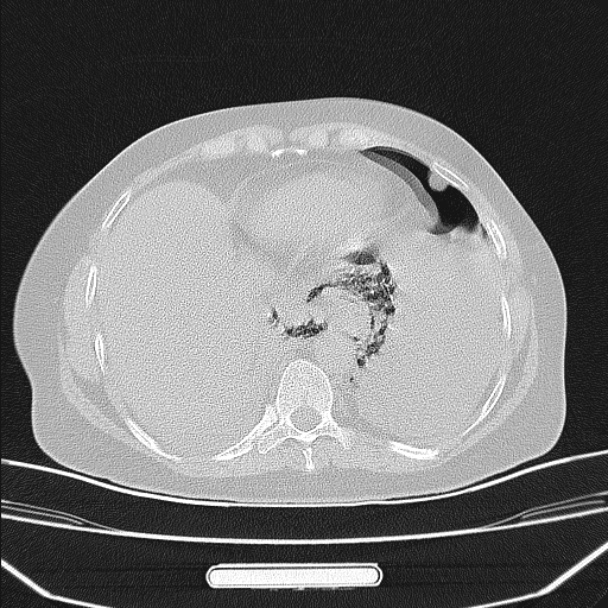 Boerhaave syndrome (Radiopaedia 45644-49799 Axial lung window 89).jpg
